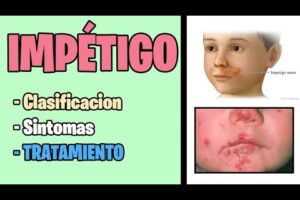 Impétigo: causas, síntomas y tratamientos para una infección cutánea común