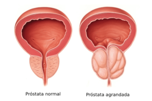 Problemas de la Próstata y Cómo Tratarlos