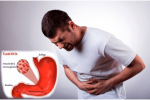 Gastritis: Causas, Síntomas y Remedios Naturales para Aliviarla