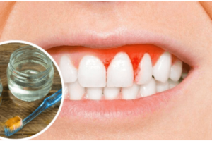 Trata la Gingivitis con Remedios Caseros Eficaces y Blanquea tus Dientes de Forma Natural