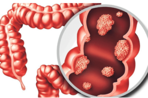 Cáncer de Colon: Síntomas, Signos de Advertencia y Consejos para la Detección Temprana