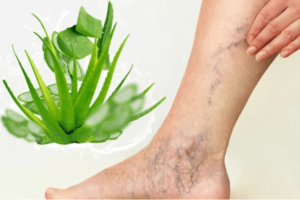 Aloe Vera para Piernas Pesadas y Várices: Remedio Natural Efectivo
