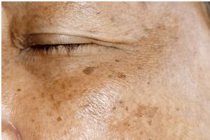 Lipofuscina en la piel: qué es, por qué aparece y cómo tratarla