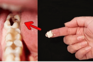 Cómo reparar y prevenir caries de forma natural: guía completa para fortalecer tu esmalte dental