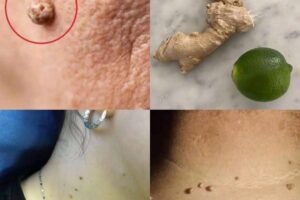 Cómo Eliminar los Fibromas Blandos de Forma Natural: ¿Funciona el Limón con Jengibre?